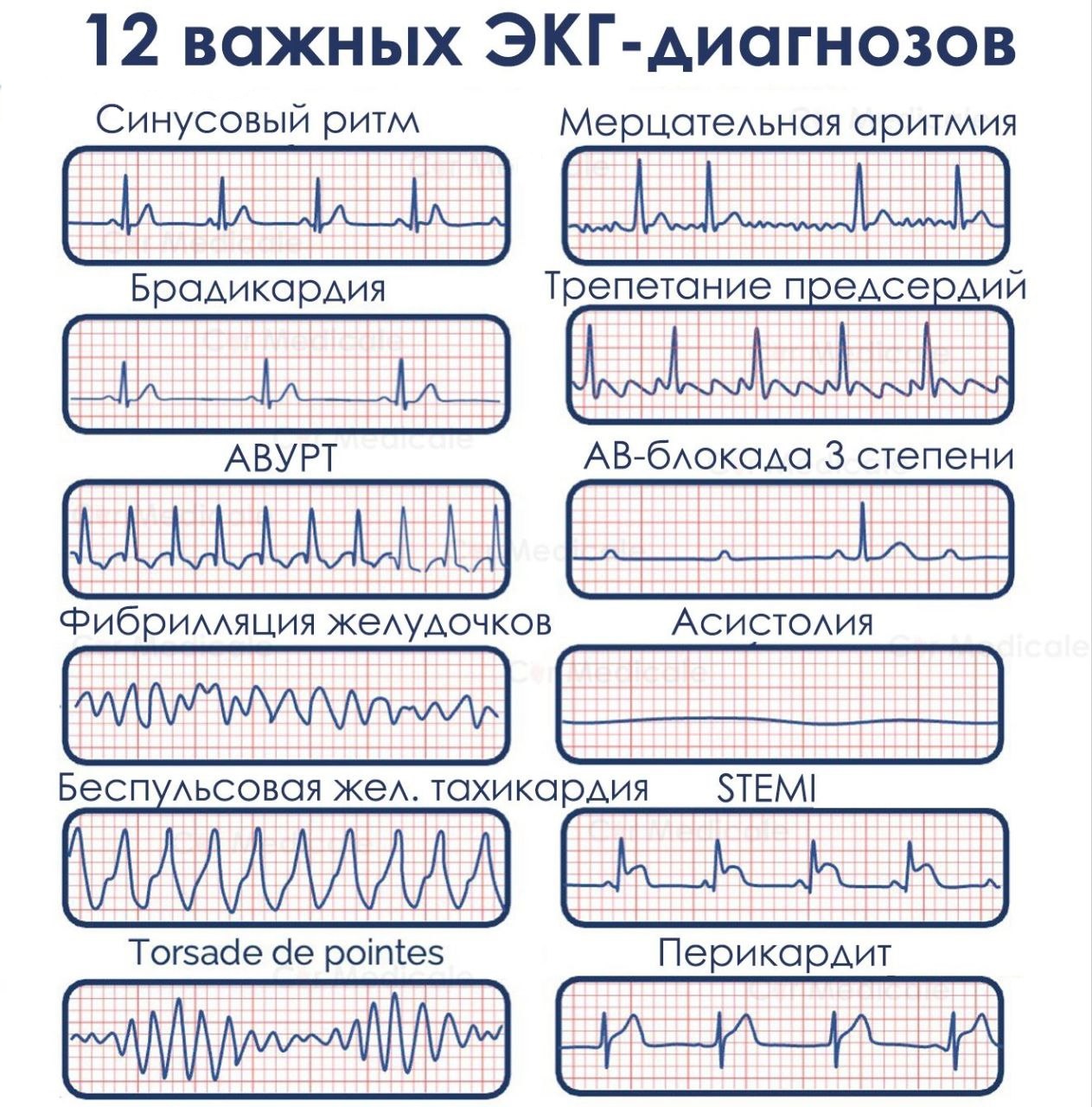Основные ЭКГ диагнозы