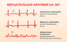 Зубцы f на ЭКГ